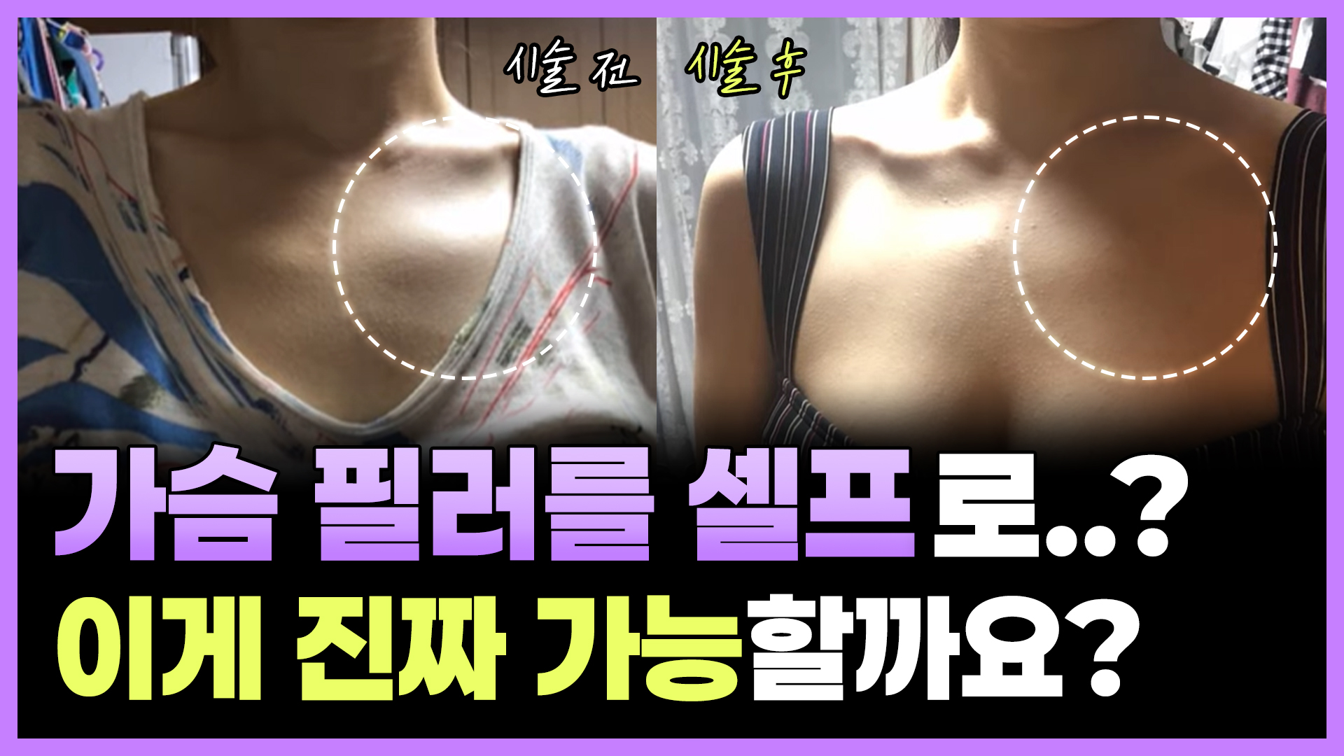 목마른닥터김 셀프 리얼 시술기
