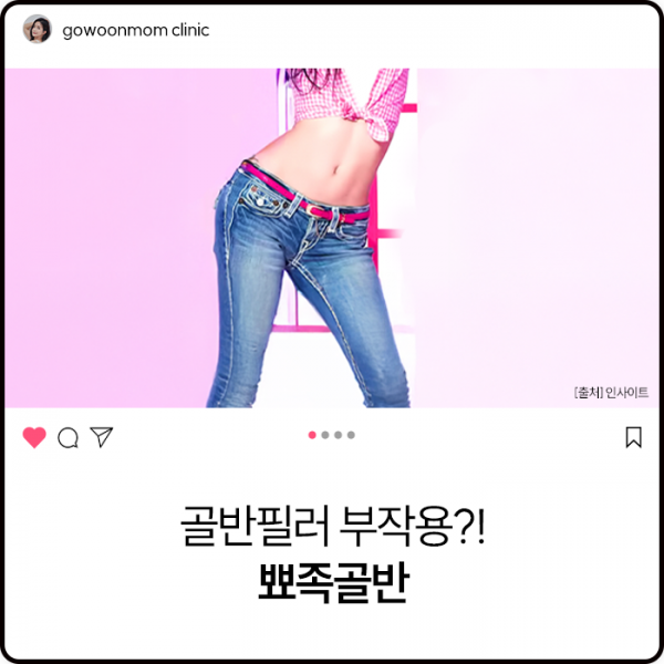 골반필러 부작용?! 뾰족골반