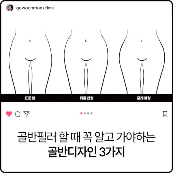 꼭 알고 가야하는 골반디자인 3가지